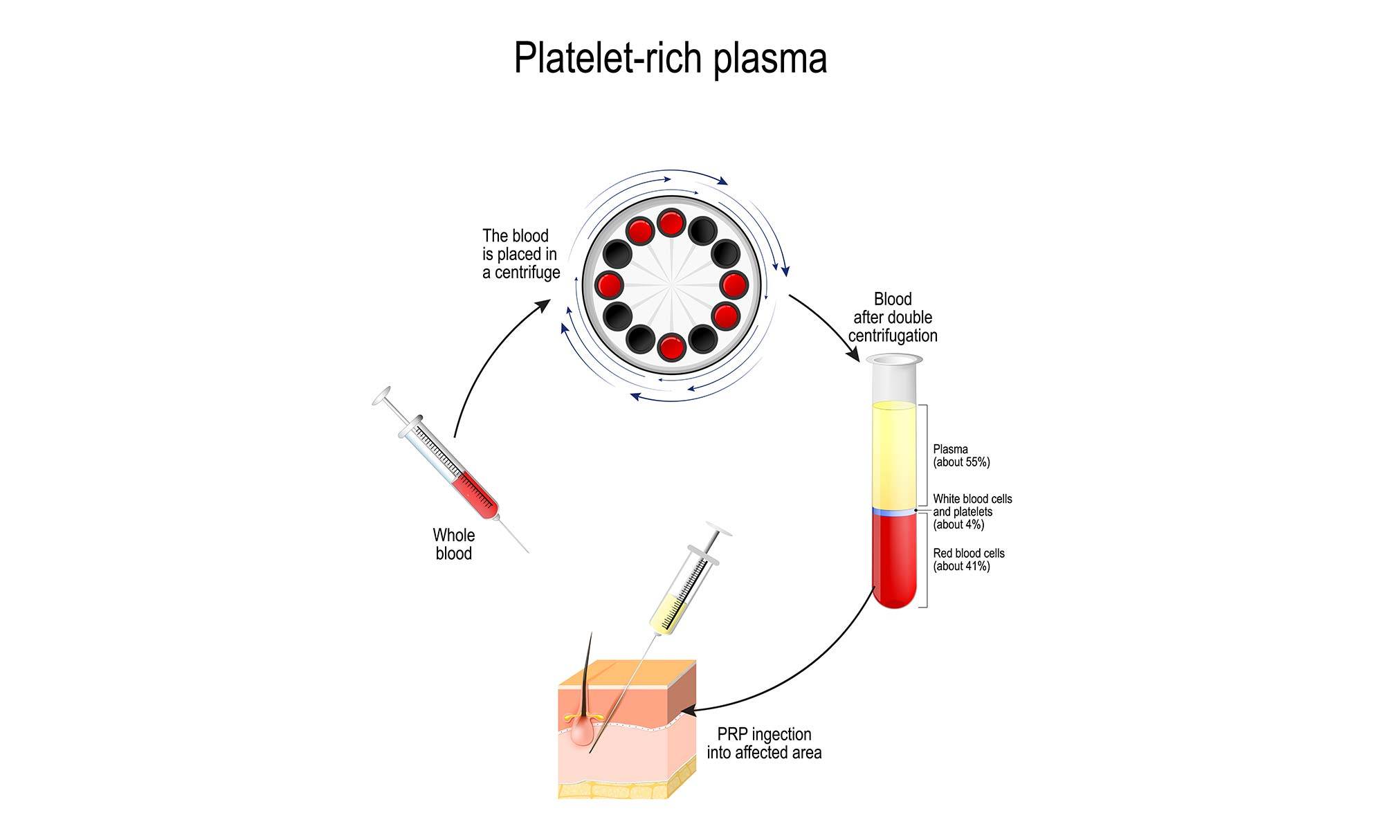 Platelette Rich Plasma Therapy, Panacea Biomedical Institute